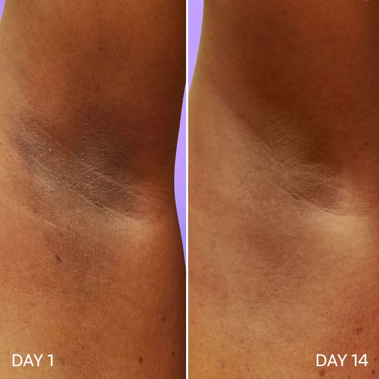 Bombae Underarm Roll on Deodorant for Women | 1% Salicylic Acid, 2% Glycolic Acid, 2% Lactic Acid| 5% AHA+BHA | No Alcohol| Prevents Odour, Reduces Pigmentation| 40 mL